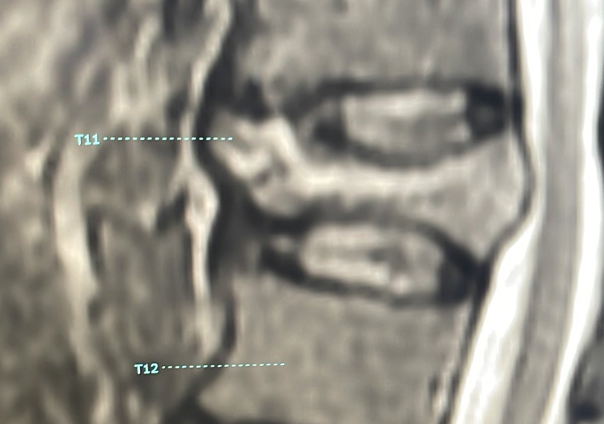 &gt;100% height increase in vertebral body height! 

Fracture reduction is critical for physiologic biomechanical function and kyphosis prevention particularly at a junctional level (T11)

#kyphoplasty #spinejack #spine #IRad #NeuroRad #radres