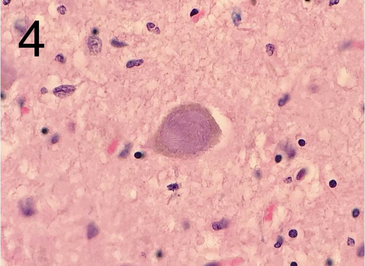 JaredAhrendsen's tweet photo. Four images from substantia nigra neurons in the midbrain. Can you name the finding in each image? 🔬 
#neuropath #autopsy #forensics #brain #pathology https://t.co/YXHzwooctp