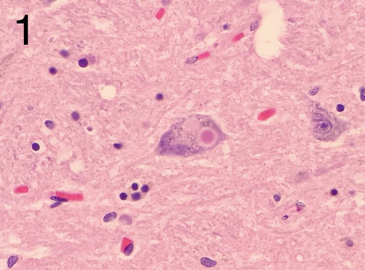 JaredAhrendsen's tweet photo. Four images from substantia nigra neurons in the midbrain. Can you name the finding in each image? 🔬 
#neuropath #autopsy #forensics #brain #pathology https://t.co/YXHzwooctp