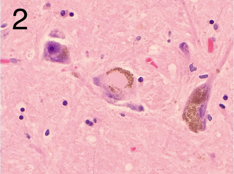 JaredAhrendsen's tweet photo. Four images from substantia nigra neurons in the midbrain. Can you name the finding in each image? 🔬 
#neuropath #autopsy #forensics #brain #pathology https://t.co/YXHzwooctp