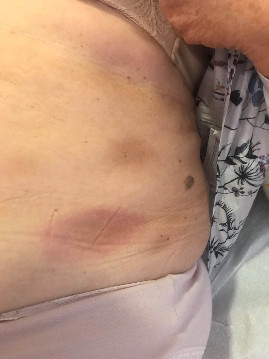 julianconejomir's tweet photo. Placas violáceas en abdomen de 3 meses de evolución. Morfea múltiple. No tienen que estar muy esclerosadas. @DermaHUVRocio https://t.co/hHXCCXGzsY