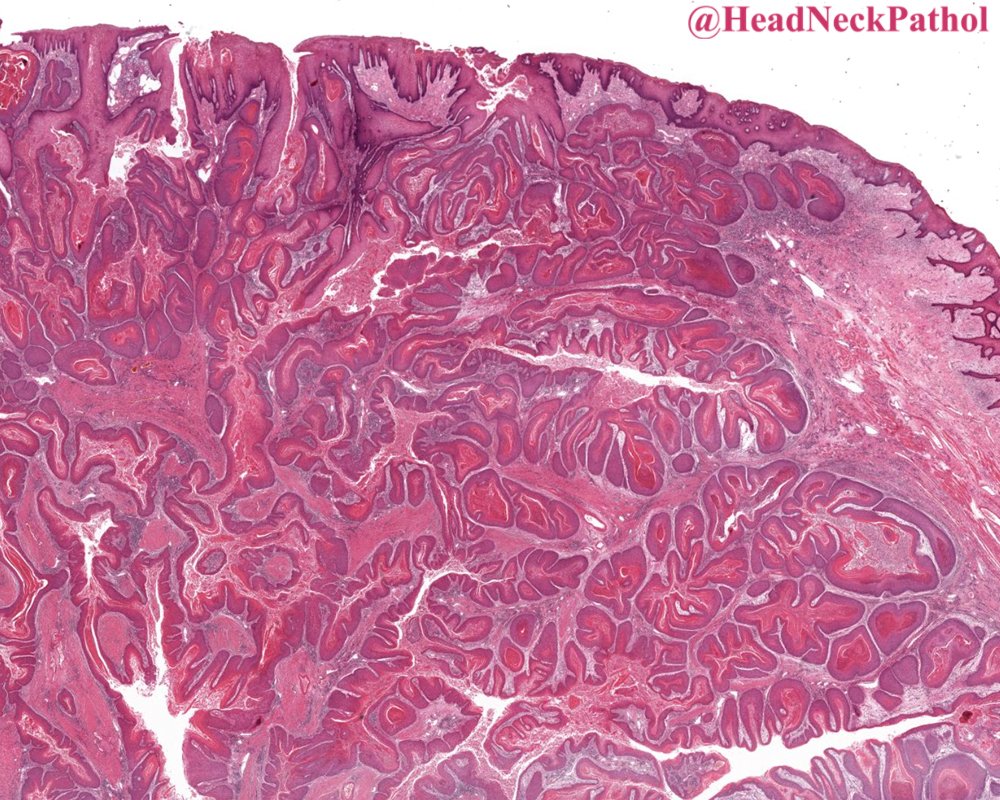 HeadandNeckPath's tweet photo. Update from the 5th Ed of World Health Organization Classification of Head and Neck Tumors: Tumours of the Oral Cavity and Mobile Tongue
By Susan Muller &amp; Wanninayake M. Tilakaratne
https://t.co/sdOHkNkjJI
#HeadNeckPathol #HNPJ #HeadandNeckPath #Pathology #ENTPath #PathologyTweet https://t.co/5je7kznxL9