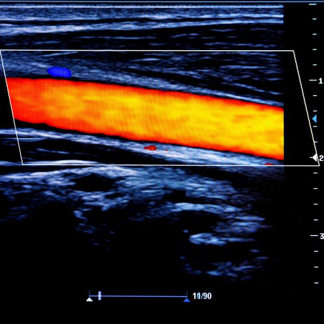Rila_GPCourses's tweet photo. In 1986, through in vitro and in vivo experiments, Pignoli and colleagues explored the distance between the inner and outer echogenic lines of a B mode ultrasound image of the common carotid artery and aorta. What did they learned?

https://t.co/rOmMVGkVww https://t.co/inasZUTquq