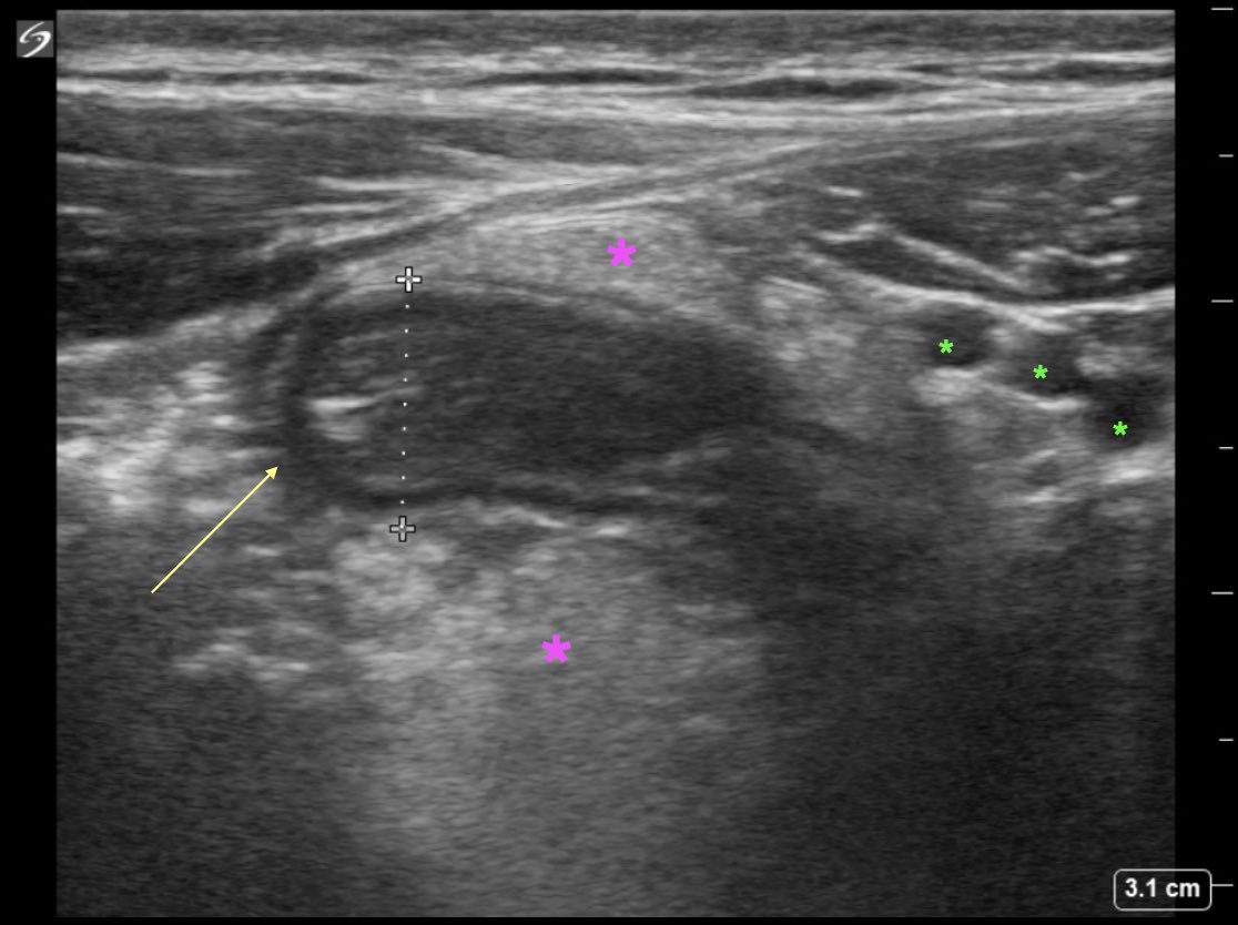 EUSmkh's tweet image. Students: What structure is represented by the yellow arrow (measuring 9mm)?
Residents: What is represented by the pink stars? What structures are the green stars indicating?
#raysofgray #POCUS #ultrasound #FOAMed #MedEd #emergencymedicine #medicalstudent #resident