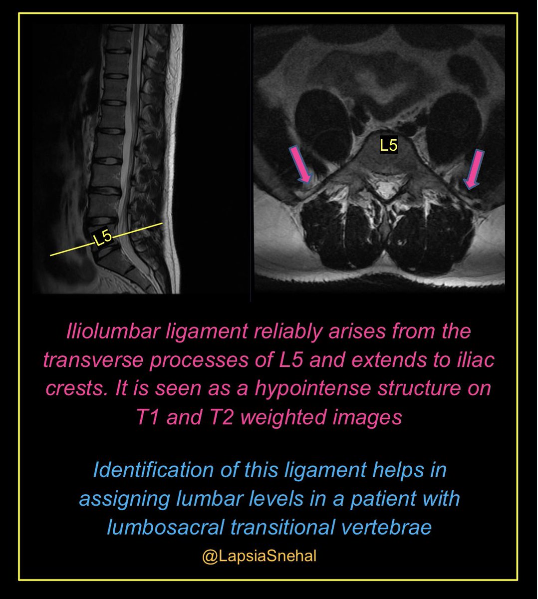 Transitional vertebrae can pose a problem when working out levels!!

#FOAMrad #FOAMed #meded  #radres #futureradres #medstudenttwitter #anatomy #frcr #surgery #radiology #radtwitter #medtwitter #mskrad #NeuroTwitter #neurorad #orthotwitter #orthorad #spine