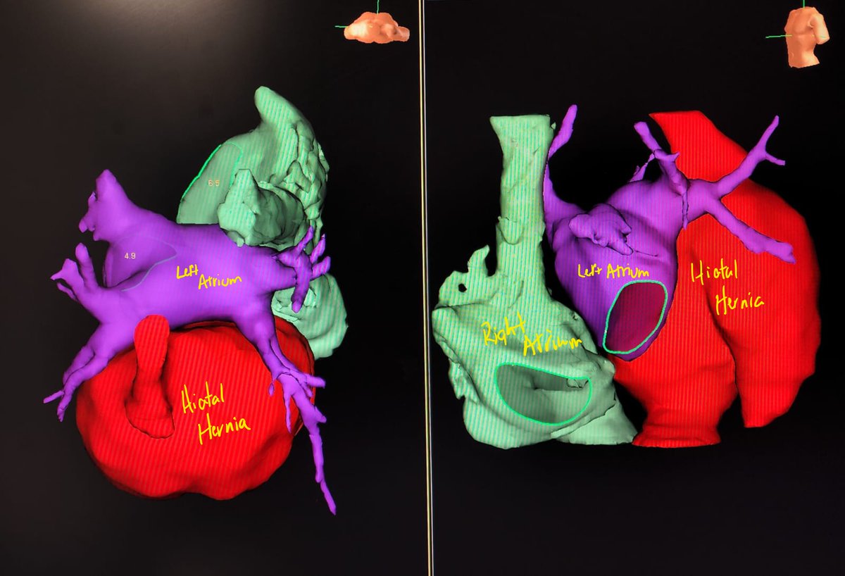 Pre-op AFib ablation CT reported a 'hiatal hernia'. Segmentation just before procedure revealed something much more impressive! I believe in pre-procedure imaging! #eppeeps #afib
