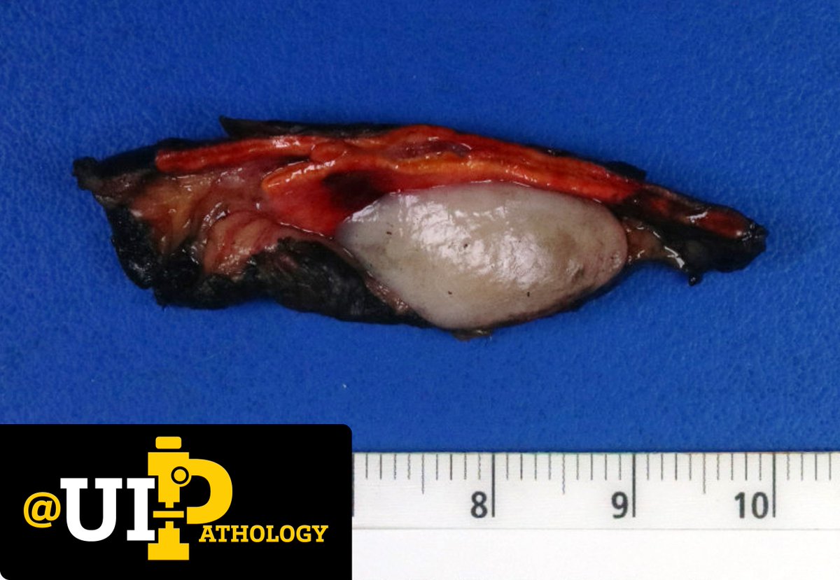 UIPathology's tweet photo. Incidentally identified intra-abdominal mass. Where is this lesion arising and what is your diagnosis?
📸: @tracyshalvorson
#IowaPath #CuteCaseConference #PathTwitter https://t.co/wmy6VUaf94
