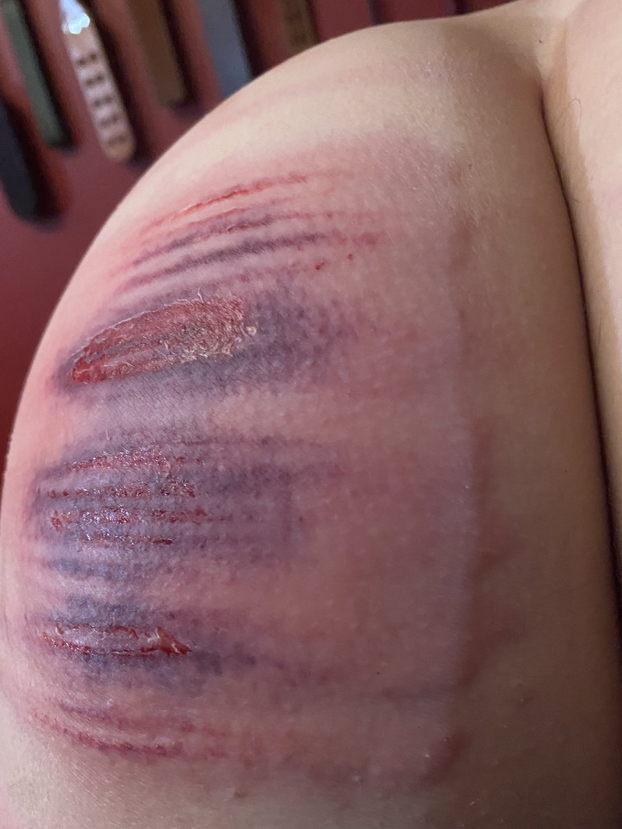 vonnie_aka_MB's tweet photo. I love seeing how the traumatised flesh swells up and the bruises bloom. https://t.co/WtfXahKru9