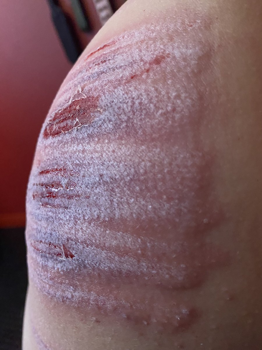 vonnie_aka_MB's tweet photo. I love seeing how the traumatised flesh swells up and the bruises bloom. https://t.co/WtfXahKru9