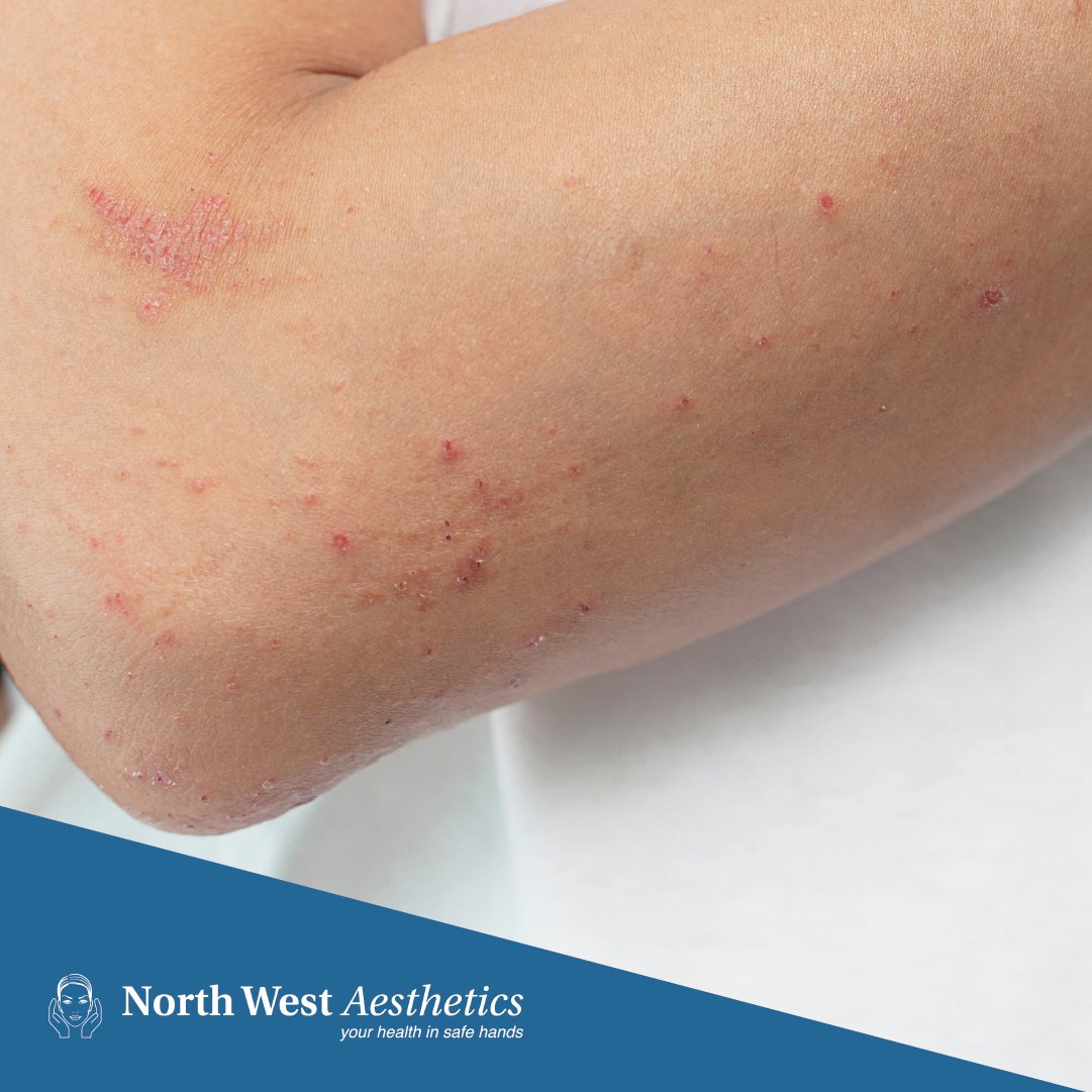 Remove benign #SkinLesions safely and effectively with the #CryoPen. A jet of nitrous oxide freezes skin tissue, rupturing the membrane of unwanted #lesions. Book your appointment at #NorthWestAesthetics.