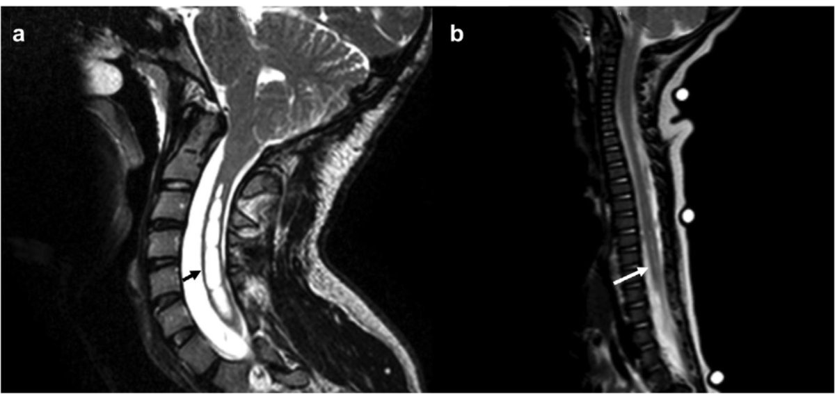 emerse (@projectemerse) on Twitter photo EMERSE used in "largest cohort of patients studied to date with syrinx and evaluation for superficial abdominal reflex". Abnl SAR common in Chiari-associated syrinx, compared w idiopathic syrinx. sciencedirect.com/science/articl⦠<a href="/jamemoss/">James M. Mossner, M.D., M.S.</a> <a href="/CormacOMaher/">Cormac O. Maher</a> <a href="/strahleMD/">Jennifer Strahle, MD</a> <a href="/umichneuro/">Michigan Neurosurgery</a> @WUSTLortho EMERSE used in "largest cohort of patients studied to date with syrinx and evaluation for superficial abdominal reflex". Abnl SAR common in Chiari-associated syrinx, compared w idiopathic syrinx. sciencedirect.com/science/articl⦠<a href="/jamemoss/">James M. Mossner, M.D., M.S.</a> <a href="/CormacOMaher/">Cormac O. Maher</a> <a href="/strahleMD/">Jennifer Strahle, MD</a> <a href="/umichneuro/">Michigan Neurosurgery</a> @WUSTLortho
