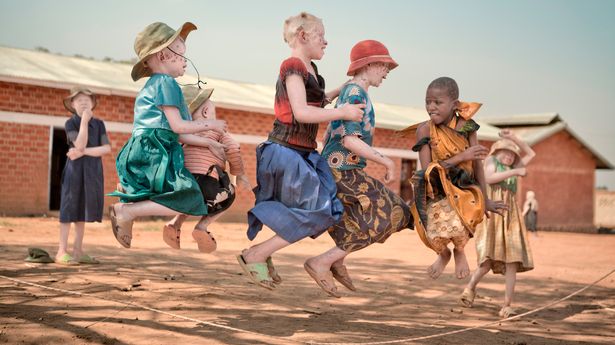 AfricaAlbinism's tweet photo. #Children with albinism need maximum sun protection to prevent the early acquisition of lesions which develops into #skincancer. #Sunscreens, long sleeve shirts and wide-brimmed hats are a must-have for children with albinism.
#skincacerkills
#fightskincancer
Photo: The Mirror https://t.co/5Y3LsMCKU0