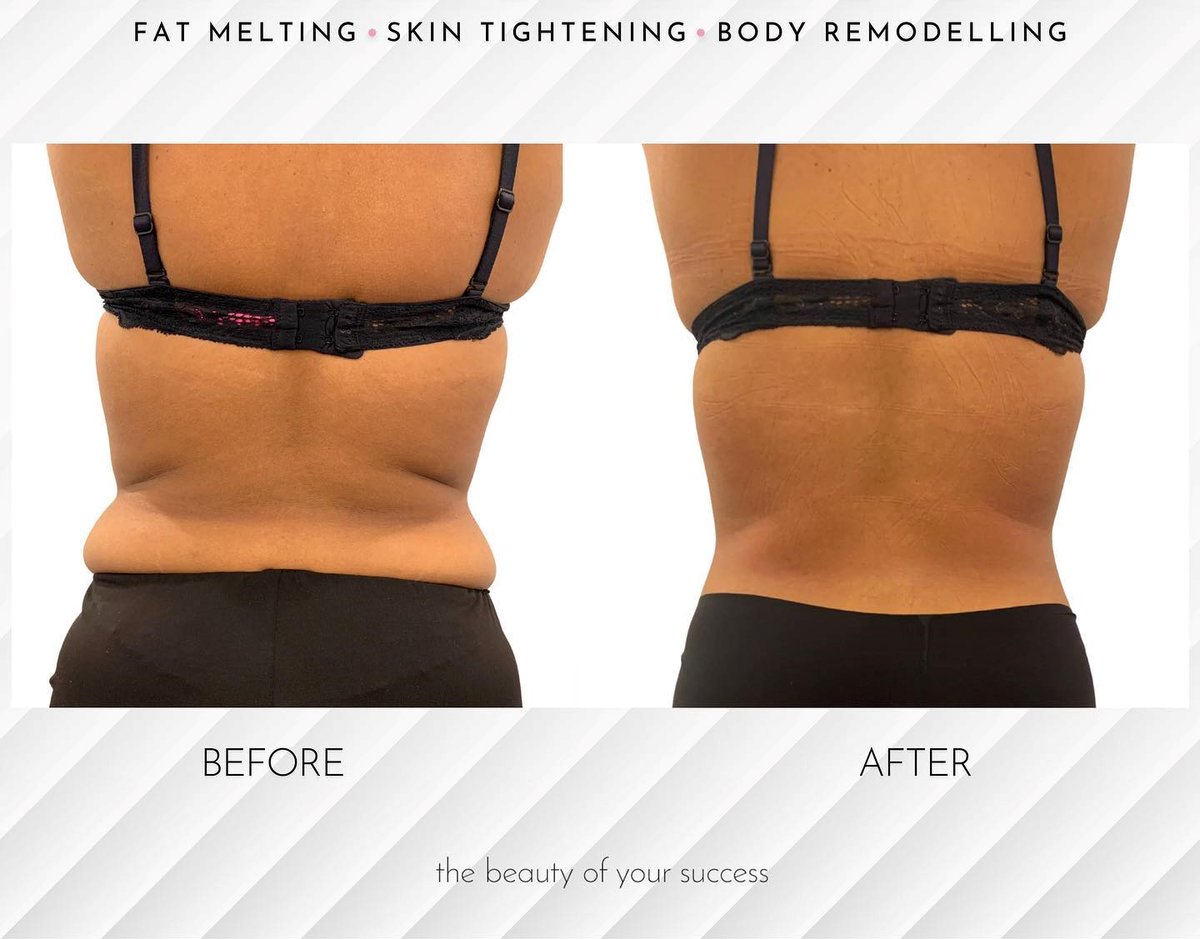 revivifymedispa's tweet photo. Spring in to Action!!! Body Contouring....Eliminate fat, shape areas of the body and tighten up your body for Summer Time!!!

#wrawesome #kwawesome #bodysculpting #bodycontouring #kitchener #waterloo #stratford #guelph https://t.co/pVrdSec5yG