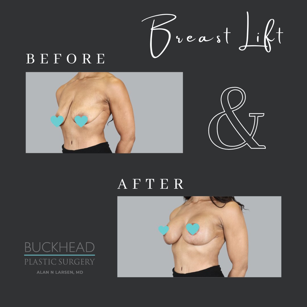 A breast lift has many medical benefits. Find out more about them in our new blog post: "Are there medical benefits to a breast lift?" 
Read more here: bit.ly/3DnIe23  &amp; Call us today at 404.367.9005 to book your consultation with Dr. Larsen.