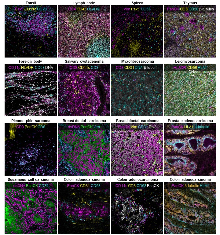 CandaceCLiu's tweet photo. Robustness and reproducibility studies are needed for technologies like #MIBITOF to be used in large translational studies and clinical diagnostics. For this study, we constructed a TMA with disease-free controls and multiple types of carcinomas, sarcomas, and CNS lesions. [2/5] https://t.co/RrFr5qDr9L