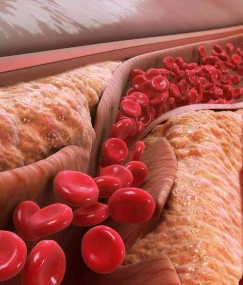 صورة توضح تأثير الدهون على الأوعية الدموية مما يسبب السكتة القلبية او تصلب الشرايين'التصلب العصيدي'