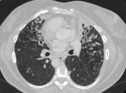DulcichGonzalo's tweet photo. Síndrome De Kartagener
-Enf Hereditaria: discinesia ciliar primaria
-Sinusitis crónica + bronquiectasias + situs inversus

 🔎F53 con exacerbación infecciosa complicada con empiema izq. 
@TLHM_MD @MarianaBenegas1 @agaser79 @marcosmestas 
#ChestRad #radres https://t.co/MufiCIqVqh
