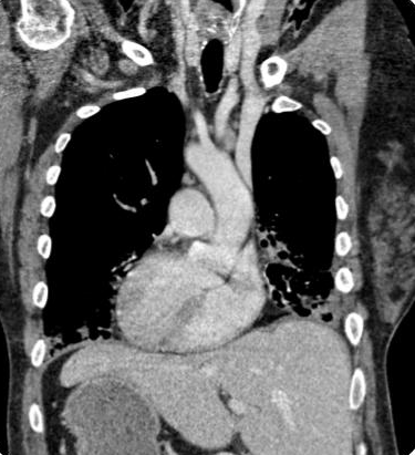 DulcichGonzalo's tweet photo. Síndrome De Kartagener
-Enf Hereditaria: discinesia ciliar primaria
-Sinusitis crónica + bronquiectasias + situs inversus

 🔎F53 con exacerbación infecciosa complicada con empiema izq. 
@TLHM_MD @MarianaBenegas1 @agaser79 @marcosmestas 
#ChestRad #radres https://t.co/MufiCIqVqh