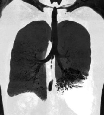 DulcichGonzalo's tweet photo. Síndrome De Kartagener
-Enf Hereditaria: discinesia ciliar primaria
-Sinusitis crónica + bronquiectasias + situs inversus

 🔎F53 con exacerbación infecciosa complicada con empiema izq. 
@TLHM_MD @MarianaBenegas1 @agaser79 @marcosmestas 
#ChestRad #radres https://t.co/MufiCIqVqh