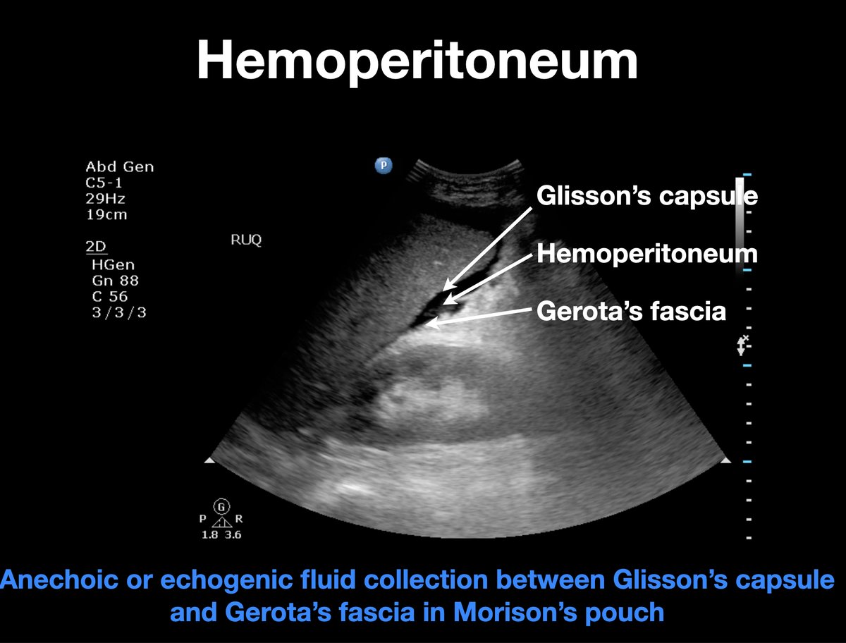 Robert Jones, DO (@rjonessonoem) on Twitter photo <a href="/NephroP/">NephroPOCUS</a> These can be difficult when only a little fat is present. No bowel present. Had renal injury. Here is a patient with hemoperitoneum and another with both hemoperitoneum and hemoretroperitoneum <a href="/NephroP/">NephroPOCUS</a> These can be difficult when only a little fat is present. No bowel present. Had renal injury. Here is a patient with hemoperitoneum and another with both hemoperitoneum and hemoretroperitoneum