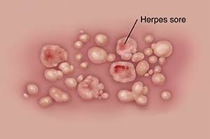 LabTestDotNg's tweet image. Herpes simplex Virus can lie dormant/asymptomatic in infected persons for years and they can still pass it on. It may not be very harmful for adults, but can be very DANGEROUS for infants. 

Get checked for HSV 1 &amp;amp; 2
Book at LabTest.ng