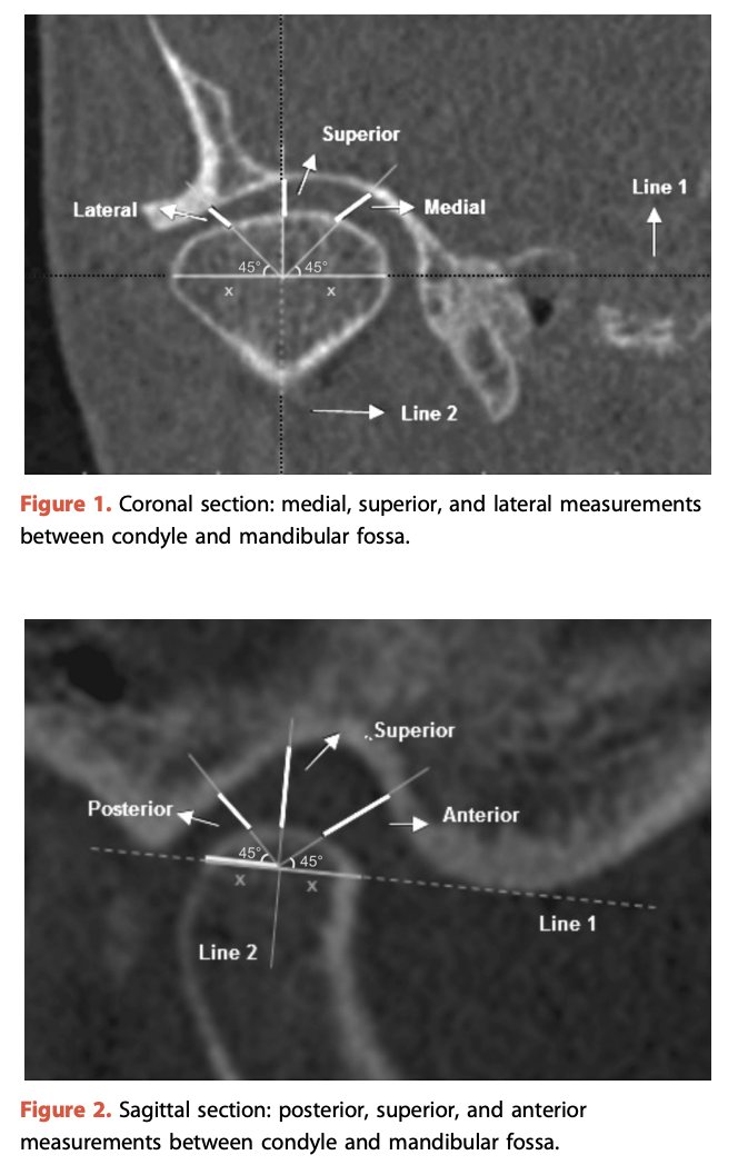 This article from the latest issue of  #theJPD studies  #centricrelation &amp; #maximalintercupsation positions based on #CBCT studies of the #condyle #mandibularfossa complex are evaluated in different age groups with &amp; without #TMD.

Learn more: thejpd.org/article/S0022-…