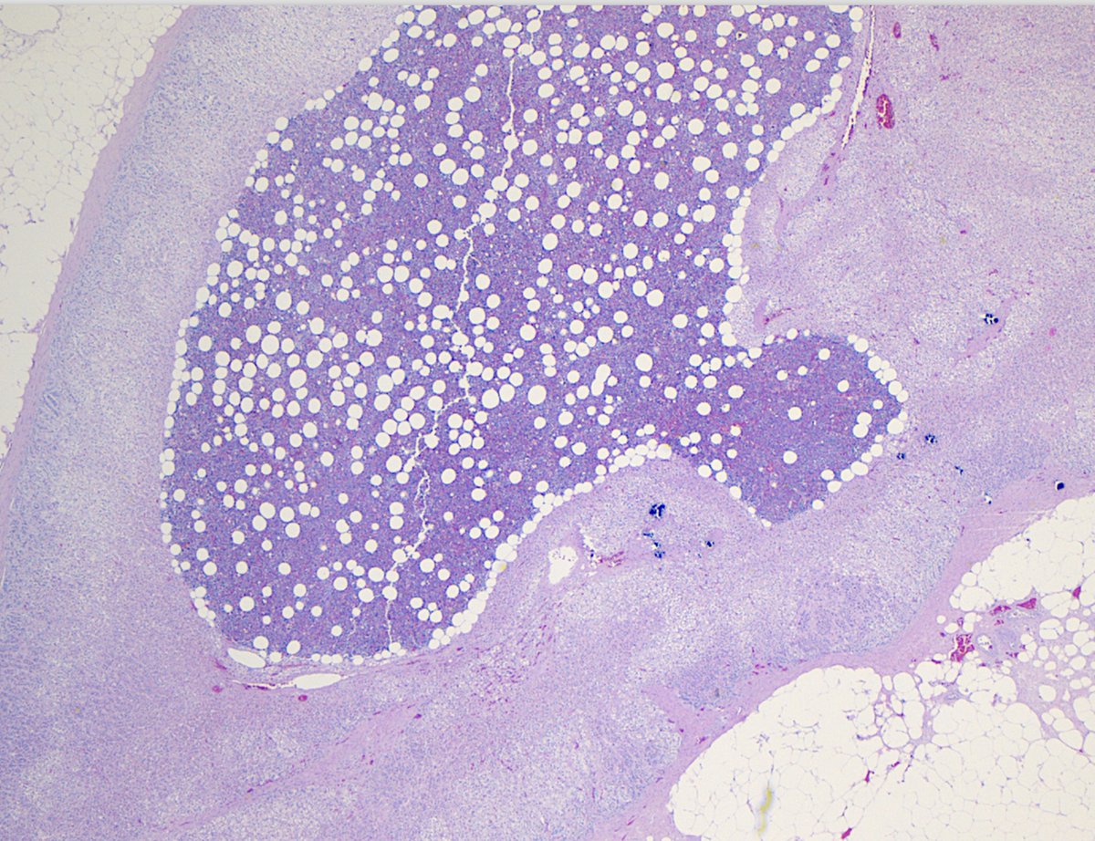 #MTPathUnknown #262
Low power view-what is diagnosis?
For anyone who wants to answer
Medical students/junior residents-this is (I think) very challenging but what is the normal organ?  Think about the appearance of the abnormal area-anything you know that matches that appearance?