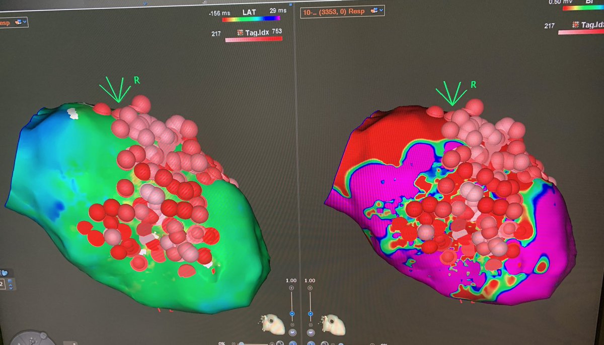 Ischemic VT ablation yesterday evening in a patient with VT storm.  Aided by our <a href="/inheartmedical/">inHEART</a> imaging highlighting areas of channels within the scar and made for a more targeted ablation approach.  Stable VT as he entered the Lab. No inducible post. Thanks <a href="/EP_JB13/">John Burke</a> <a href="/atolat3/">Aneesh Tolat</a>