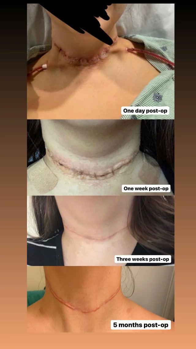 thyroidgroups's tweet photo. Posted this scar progression photo a few months ago. Just added a photo. Lots of pics on here of well healed scars (which is amazing) but here is one that doesn’t look so beautiful.
#thyroid https://t.co/RdGMcjAnIr