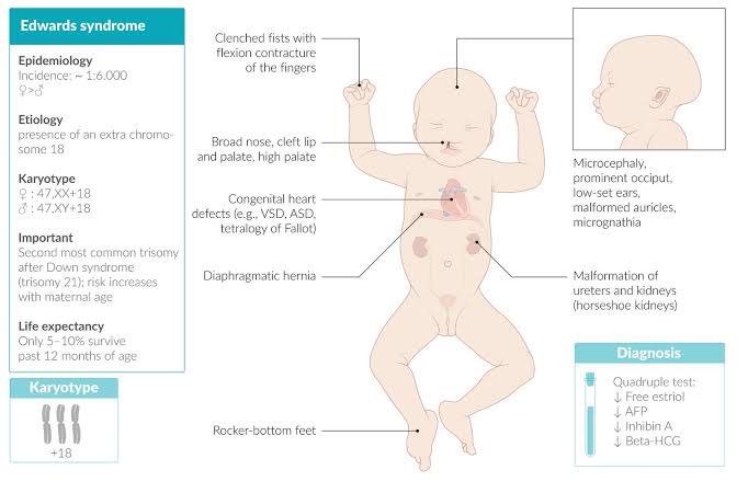 m1ss_DML's tweet photo. Saw my first Trisomy 18 https://t.co/JvStFPuR8Z