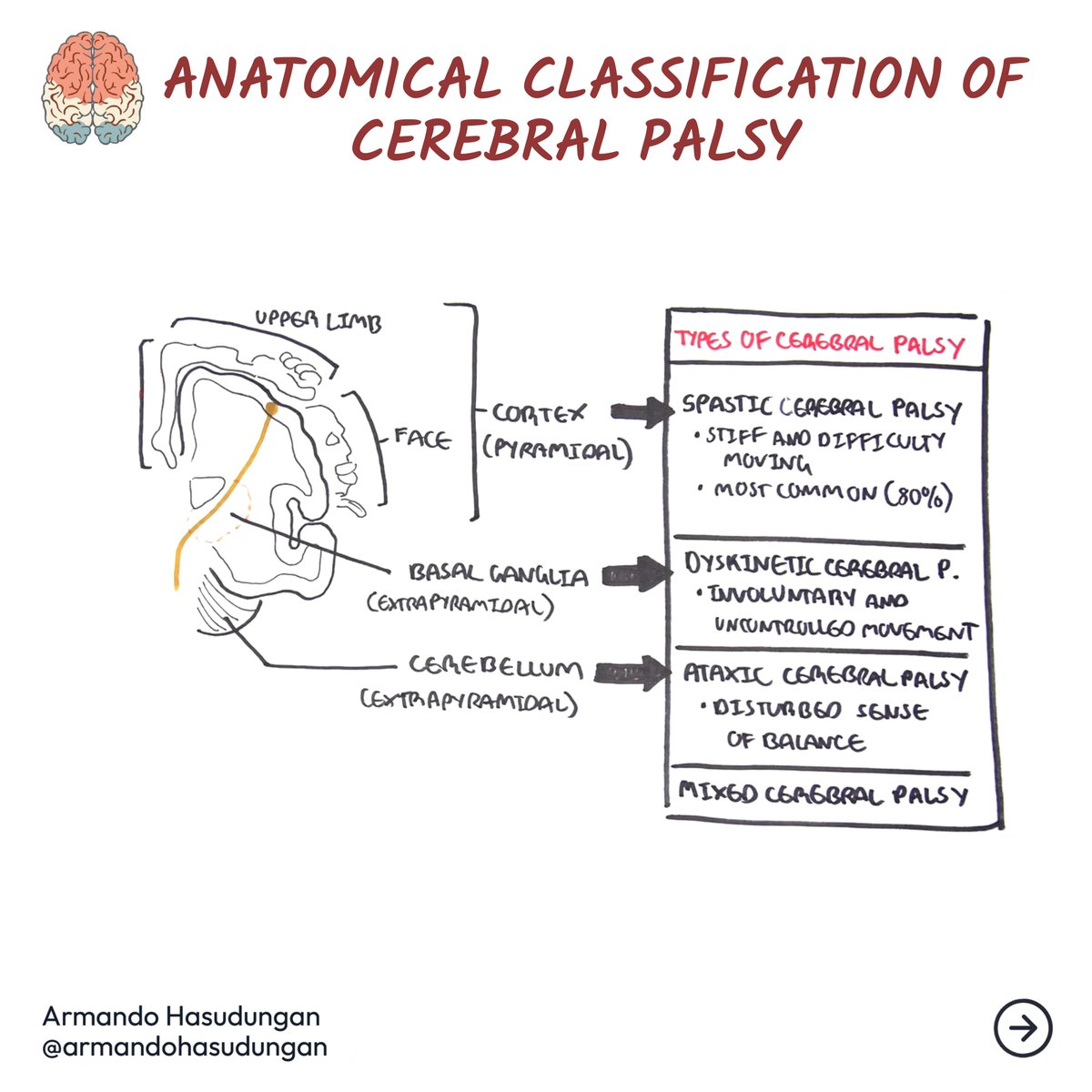 armandohasudung's tweet photo. Cerebral palsy (CP) is a group of disorders that impact a person's ability to move, balance, and maintain posture.
Know more @ https://t.co/FV1gYBPvpZ
Read more, Follow us @ https://t.co/El1edfrtSJ

#cerebralpalsy #CP #mixedCP #ataxicCP #spasticCP #dyskineticCP #briandamage https://t.co/PiZ2OQ9Pbb