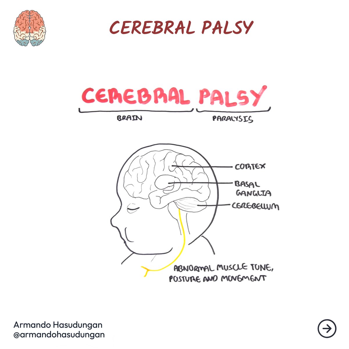 armandohasudung's tweet photo. Cerebral palsy (CP) is a group of disorders that impact a person's ability to move, balance, and maintain posture.
Know more @ https://t.co/FV1gYBPvpZ
Read more, Follow us @ https://t.co/El1edfrtSJ

#cerebralpalsy #CP #mixedCP #ataxicCP #spasticCP #dyskineticCP #briandamage https://t.co/PiZ2OQ9Pbb
