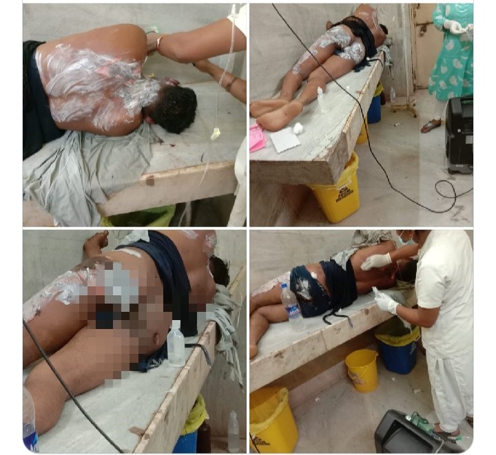 एक विद्युत ठेका कर्मचारी करंट की चपेट मे आ गया जान का रिस्क होने के बाद भी इस विभाग के ठेका कर्मचारी का वेतन इतना कम क्यों है आप सभी के घर क़ो रोशन एक ठेका कर्मचारी ही करता है l
<a href="/bhupeshbaghel/">Bhupesh Baghel</a>
#विद्युत_विभाग_से_ठेका_प्रथा_बंद_करो