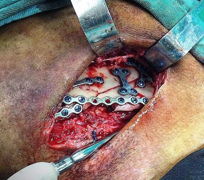 SURGICAL_Tm's tweet photo. What happens when you shatter most your facial bones in a club fight etc

You get a Maxillofacial surgeon to reconstruct them with arch bars,wires plates&amp;screws.
It's a quite extensive surgery that needs alot of symmetry to attain a proportional look dodging arteries and nerves. https://t.co/w76pFXxAKG