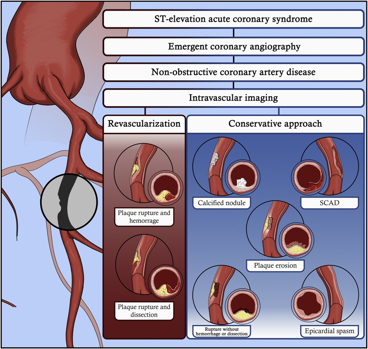 DFCapodanno's tweet photo. In STEMI, the ability of intracoronary imaging to differentiate between plaque rupture and nonrupture is potentially helpful in decision-making for subsequent treatment strategies, including avoidance of stenting. Our editorial to the EROSION III trial.
https://t.co/QymgaXDXw3 https://t.co/09EKiCM9ut