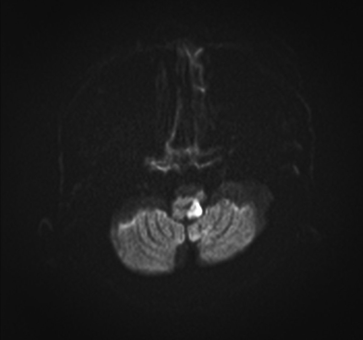 tim5official's tweet photo. 30/M with sudden onset intractable hiccups, left-sided facial numbness, absent gag reflex, and tinnitus #Stroke #TimeIsBrain https://t.co/mYVCW21wtV