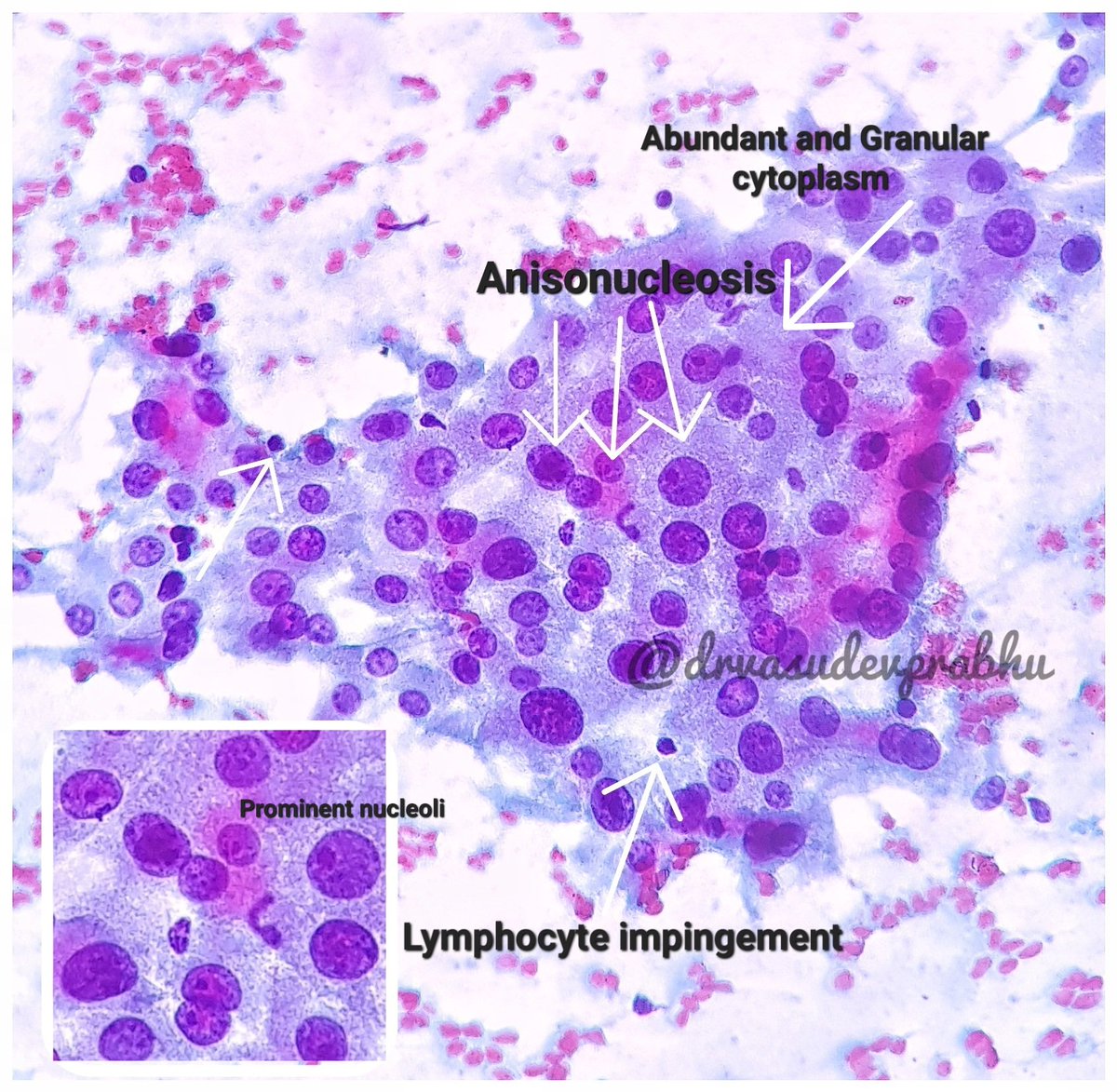 DrVasudevPrabhu's tweet photo. Hurthle cell change in hashimoto's thyroiditis 💙❤️ #cytopathology #basicsincytopathogy  #pathboards #pathspotters #PathTwitter @anjuthevirgo @DrApoorvaN1 @premcharles @kriyer68 @RizviUroos https://t.co/G25c1QgdE9