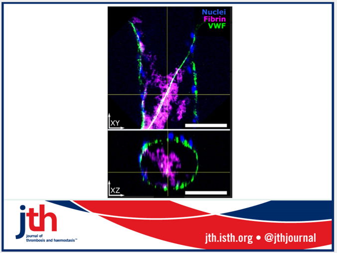 JTH (@jthjournal) on Twitter photo New article: During #thrombosis, rapid endothelial release of von Willebrand Factor multimers may provide a scaffolding for fibrin polymerization and accelerate microvascular occlusion. <a href="/YingZhe47280253/">Ying Zheng</a> <a href="/sg_rayner/">Sam Rayner</a> <a href="/UWISCRM/">ISCRM at UW</a> @UWbioE bit.ly/3857sXi New article: During #thrombosis, rapid endothelial release of von Willebrand Factor multimers may provide a scaffolding for fibrin polymerization and accelerate microvascular occlusion. <a href="/YingZhe47280253/">Ying Zheng</a> <a href="/sg_rayner/">Sam Rayner</a> <a href="/UWISCRM/">ISCRM at UW</a> @UWbioE bit.ly/3857sXi