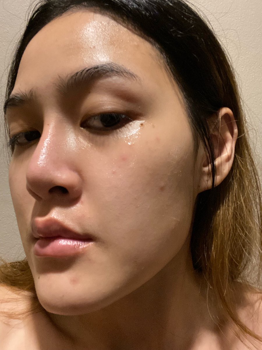 yoyeppch_'s tweet photo. อาทิตย์ที่แล้วหน้าพังจนจิตตกไปพักใหญ่ บางคนอาจคิดว่าไม่เห็นเยอะแต่สำหรับเราคนที่สิวขึ้นยากอันนี้คือเยอะสุดในชีวิตเลย แบบเครียดมากจริงๆ แล้วดันไปเจอรีวิวนึงเลยลองใช้ตามเพราะตอนนั้นคิดว่าไม่มีอะไรจะเสียแล้ว สรุปคือปังมากกก กู้หน้าภายในไม่ถึงอาทิตย์เฉยยย จนต้องมาบอกต่อ https://t.co/J7OYZ1SFNO