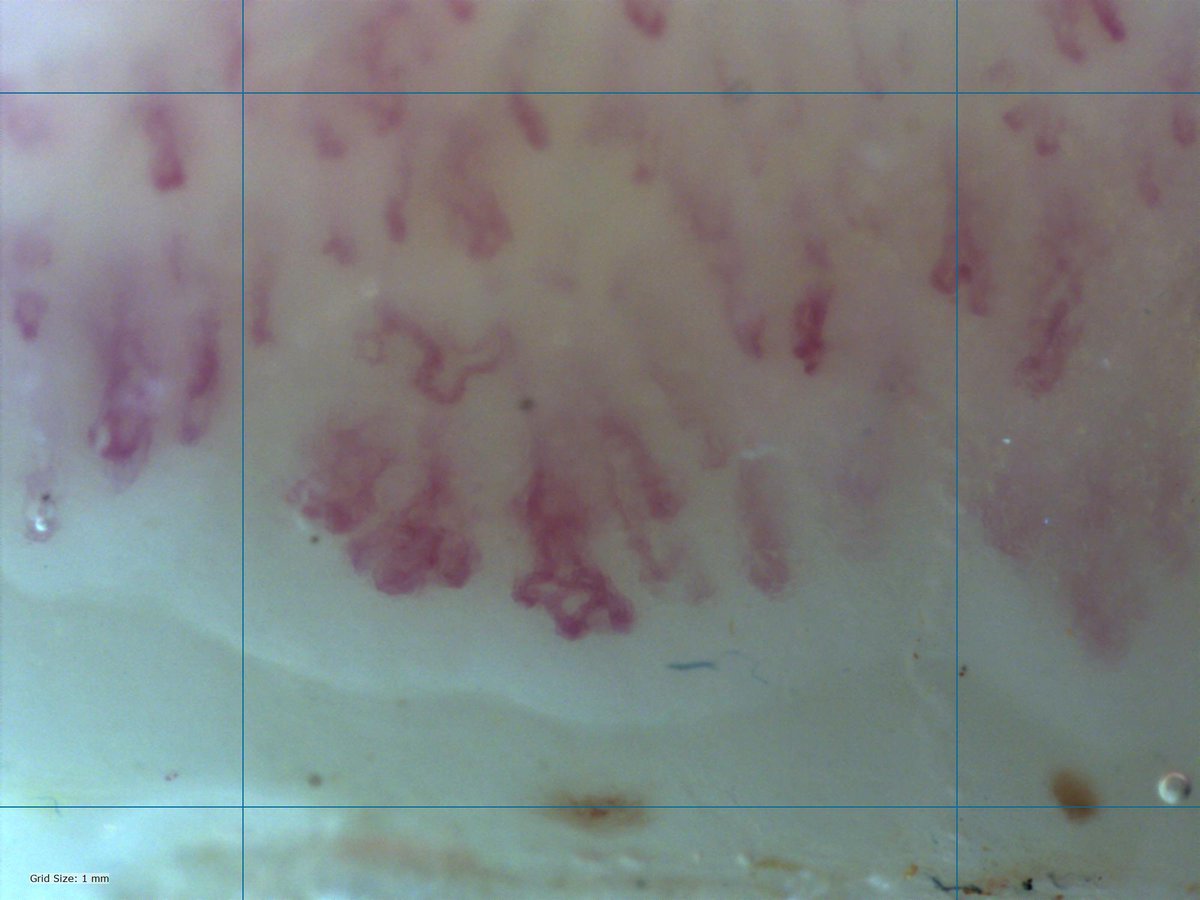 A patient in her Early 40s with New #Raynaud for 6 months. Look at that #ANA, and see right below it (something I missed at 1st glance)… important not to ignore that! This is her #Capillaroscopy 

What will you do?