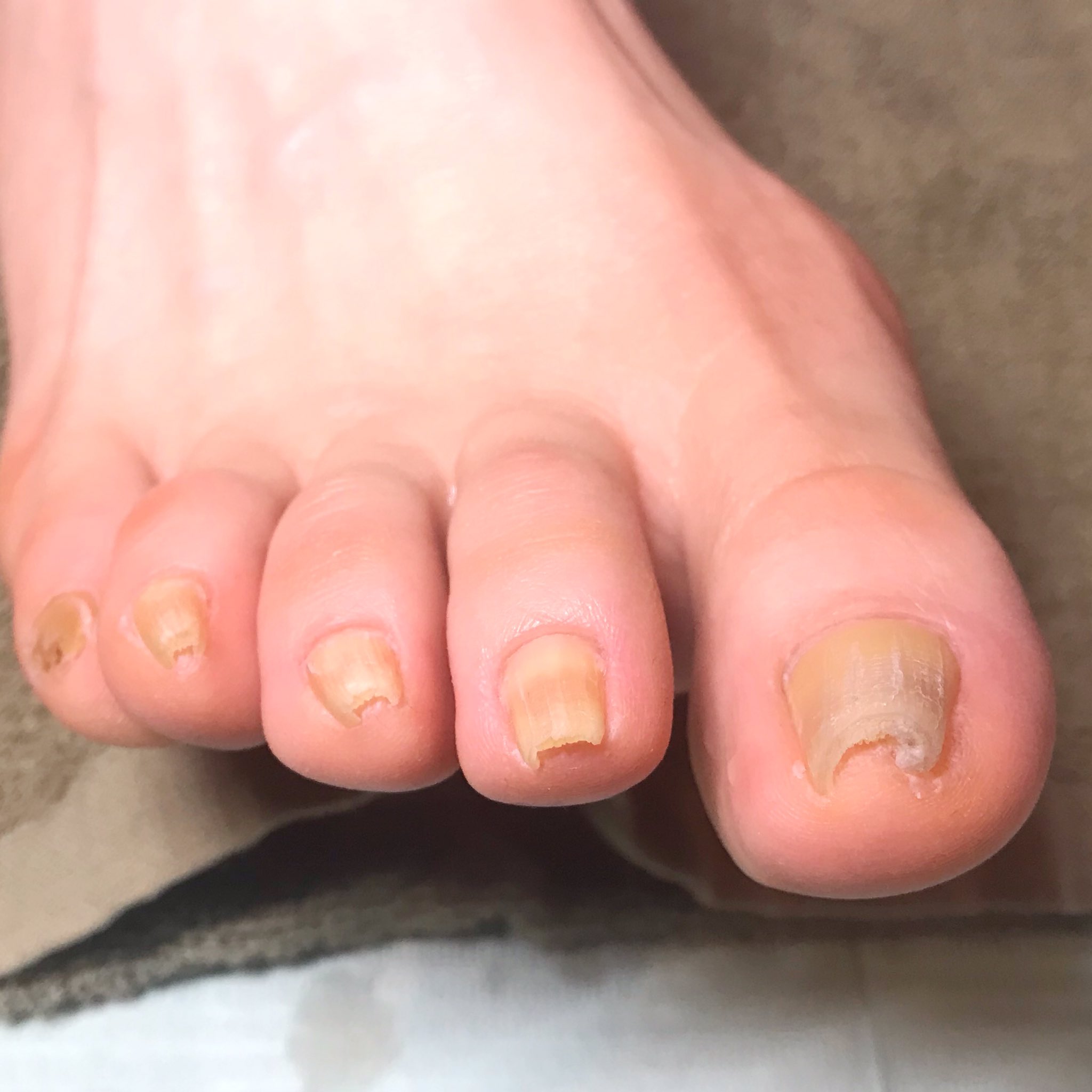 Pono Nails 巻き爪でお悩みだった方へケアをしてフットネイルをしたら喜ばれました フットネイル フットケア 巻き爪 T Co Wpgfyzxgsz Twitter