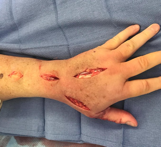 DrJustinAlbert1's tweet photo. Necrotizing Fasciitis of the Hand After a Prolonged Endodontic Procedure

@LARKINHOSPITAL
 
@MiamiHand

https://t.co/LU055ppD0f https://t.co/ntKxPskrQY