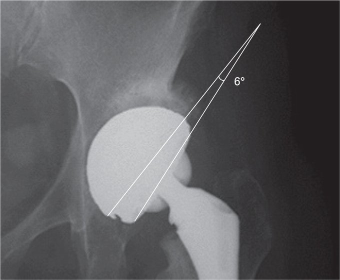 woolley_dr's tweet photo. Malseating of modular liners in dual mobility constructs can occur. The possibility of fretting & corrosion at this interface may be exacerbated in instances of malseating. Surgeons should be aware of this phenomena.
#dualmobility #ortho
@HipSoc
https://t.co/8y8fdxmGxx https://t.co/7momcPTCm8