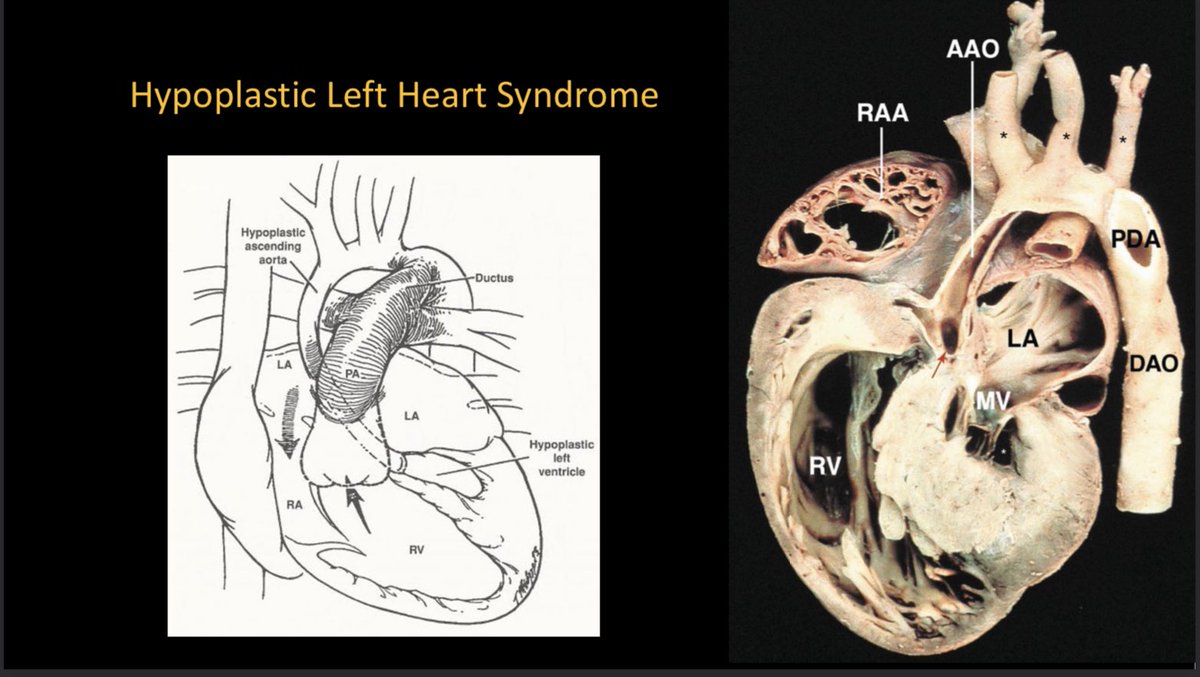DrSeanBarnes's tweet photo. Dr. Jacobs - HLHS, the ‘clinical challenge’

#CCAS2022 #SPAFL2022 #PedsAnes #PedsCardsAnes #PedsCards #PedsICU #PedsCICU https://t.co/7skdAp29Ym