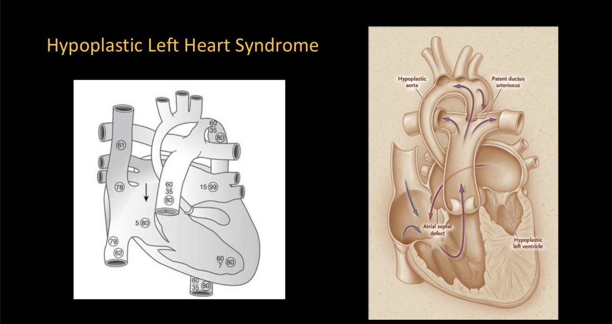 DrSeanBarnes's tweet photo. Dr. Jacobs - HLHS, the ‘clinical challenge’

#CCAS2022 #SPAFL2022 #PedsAnes #PedsCardsAnes #PedsCards #PedsICU #PedsCICU https://t.co/7skdAp29Ym