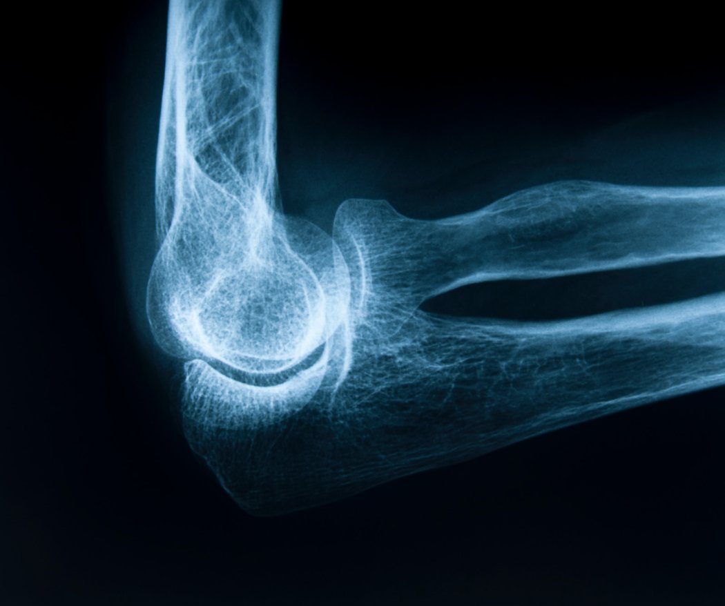 rileywilliamsMD's tweet photo. What are #bonespurs or #osteophytes?

Osteophytes are bony protrusions that form on the ends of bones within joints. Bone spurs may form in the elbow due to #osteoarthritis or degenerative joint disease. More details here: https://t.co/AzsnJGXIK8 https://t.co/3VJvaya31V