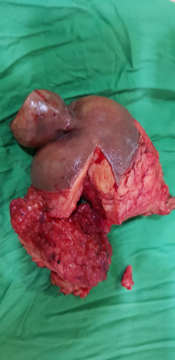 Bahaya suntik minyak ke dalam alat vital

==A Thread==
Bismillaah

Kita sbg laki2 ingin terlihat per...