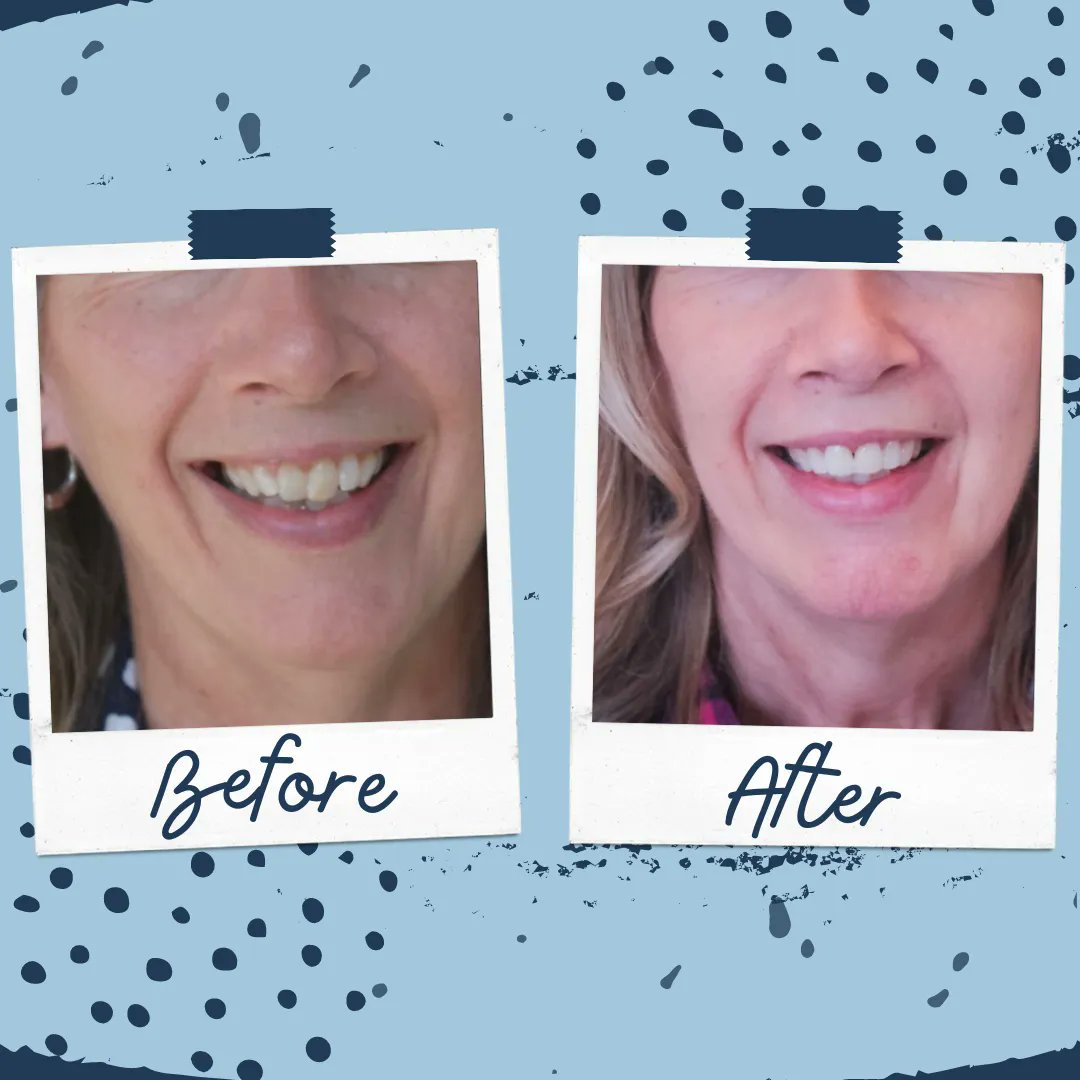 Our Providers Are Awesome! Check out this #BeforeAndAfter shared by Penarth Dental Healthcare