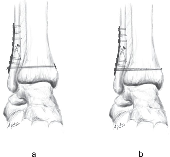 DrJustinAlbert1's tweet photo. Five years after syndesmotic injury treated with either suture button or syndesmotic screw, we found better AOFAS and OMA scores, and lower incidence of ankle OA, in the suture button group.

#arthritis #ortho

https://t.co/8WOi0rEDYN https://t.co/nNswhstbd2