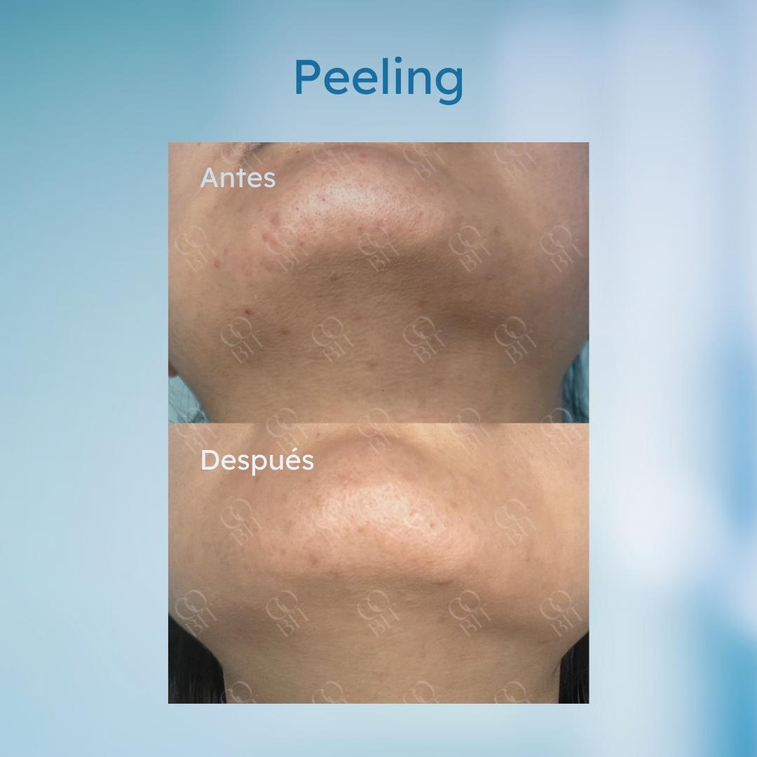 GoBIT_clinic's tweet photo. Te ayudamos a controlar el brote de acné con peeling químico. Preparemos la piel a su mejor estado para disfrutar el verano.

Consulta con nuestros especialistas. La mejor tecnología en las mejores manos.

#GoBIT #BodyBackInTime #GoBITBackInTime
#belleza #estetica #skincare #Piel https://t.co/nYKiLppqa0